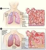 cicatriz pulmon