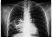 cicatriz tuberculosis pulmonar