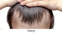 edad alopecia estabiliza androgenetica