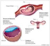 embarazo beta aumenta ectopico evoluciona