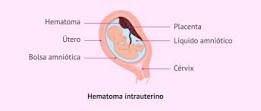 utero hematoma reabsorbe