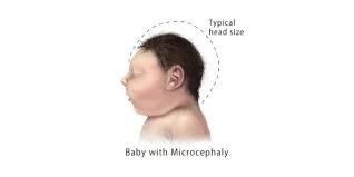 adulto leve microcefalia