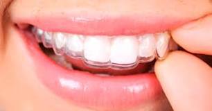 diente limpiar retenedor transparente