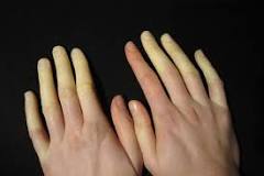 guante compresion sindro raynaud