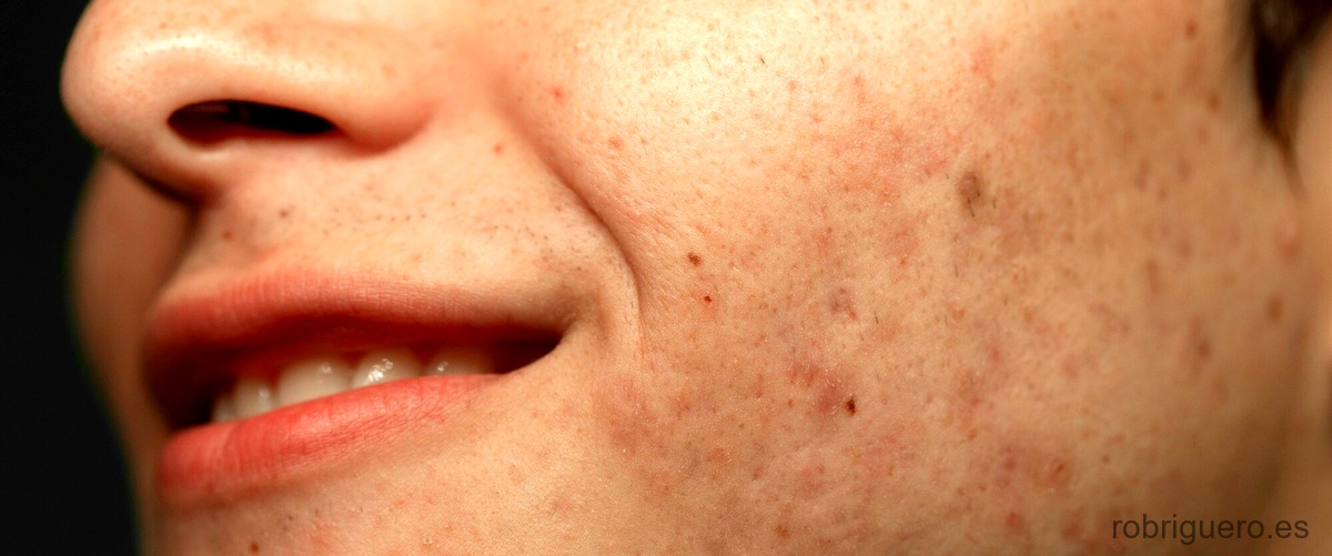 ¿Cómo identificar las manchas en la piel?