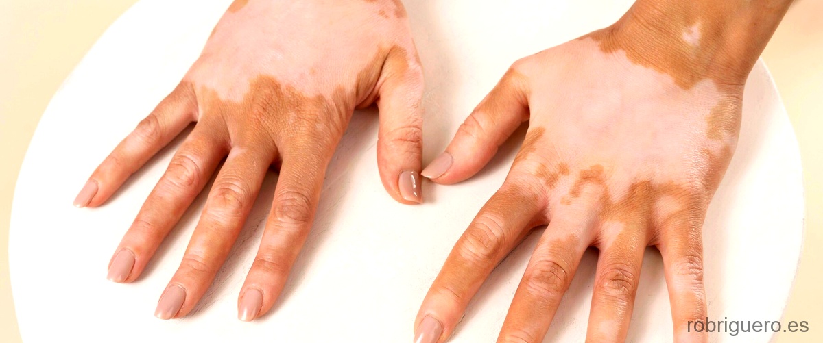 ¿Cómo saber si la dermatitis es causada por el estrés?