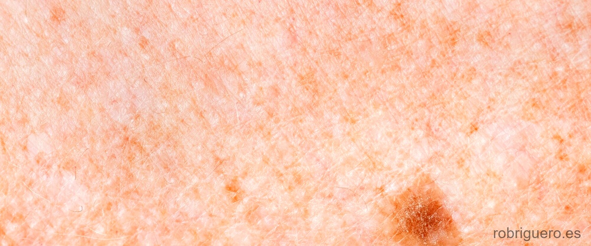 ¿Cuándo hay que preocuparse por una mancha en la piel?