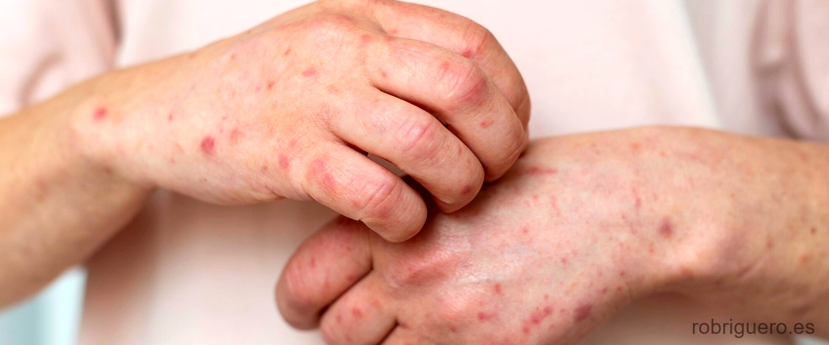 Pregunta: ¿Cómo se manifiesta la dermatitis por ansiedad?